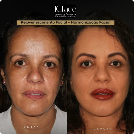 Cirurgias da Face - ICFace Pernambuco