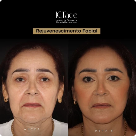 Cirurgias da Face - ICFace Pernambuco