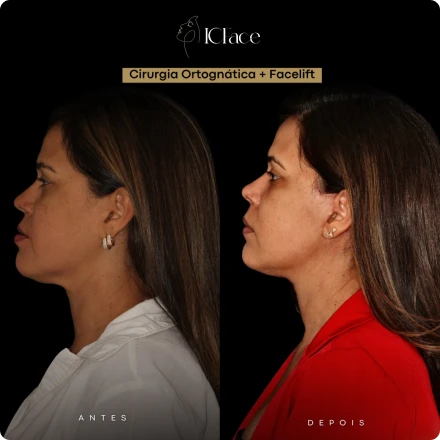 Cirurgias da Face - ICFace Pernambuco