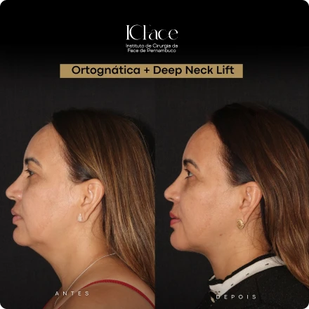 Cirurgias da Face - ICFace Pernambuco