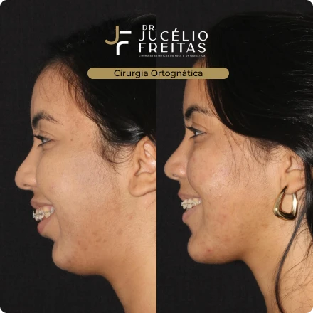 Cirurgias da Face - ICFace Pernambuco