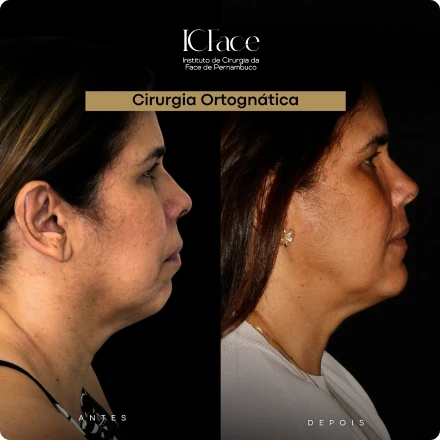 Cirurgias da Face - ICFace Pernambuco