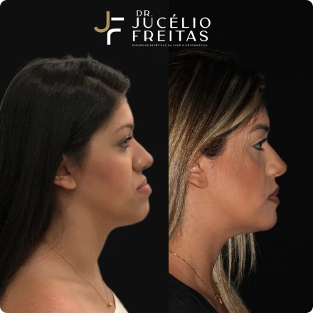 Cirurgias da Face - ICFace Pernambuco